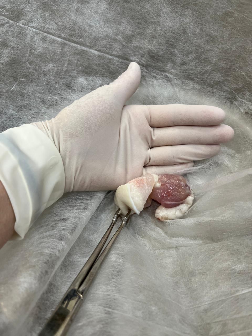 В Балакове медики спасли мужчину с застрявшим в горле куском сала