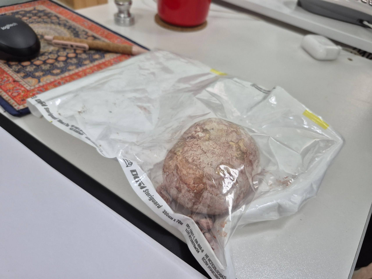 Килограммовый камень извлекли балаковские хирурги из мочевого пузыря 65-летнего пациента Килограммовый камень извлекли балаковские хирурги из мочевого пузыря 65-летнего пациента