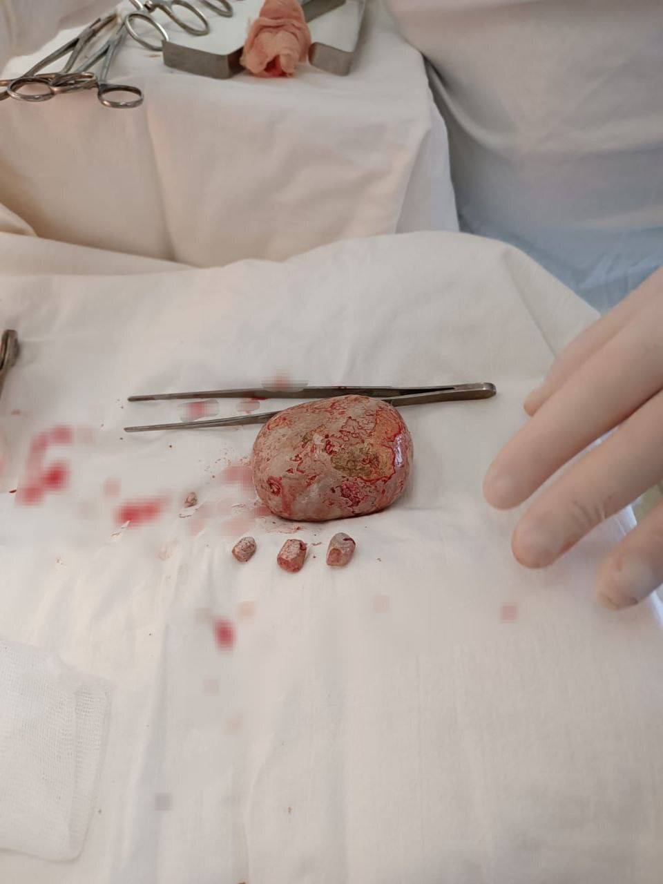 Килограммовый камень извлекли балаковские хирурги из мочевого пузыря 65-летнего пациента Килограммовый камень извлекли балаковские хирурги из мочевого пузыря 65-летнего пациента