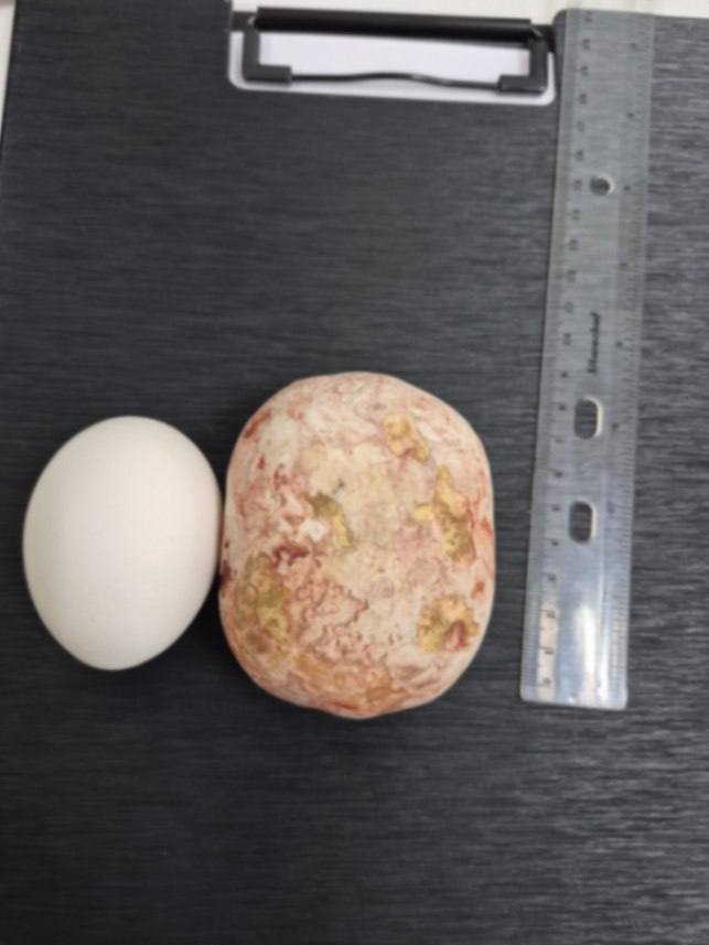 Килограммовый камень извлекли балаковские хирурги из мочевого пузыря 65-летнего пациента Килограммовый камень извлекли балаковские хирурги из мочевого пузыря 65-летнего пациента