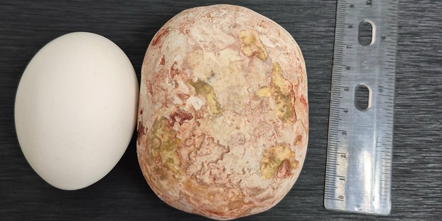 В Балакове из мочевого пузыря мужчины достали камень весом около килограмма