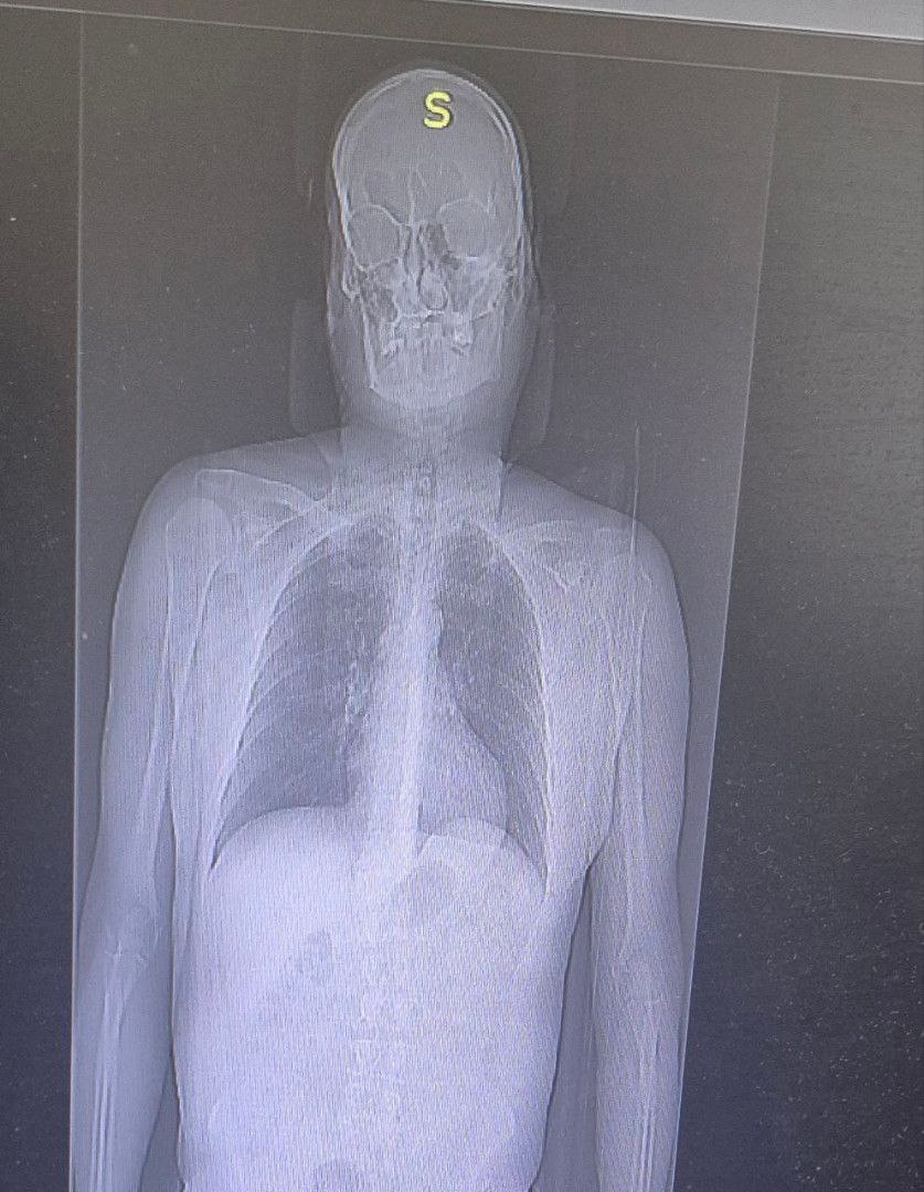 Житель Саратовской области упал с "Эйфелевой башней": два сломанных ребра Житель Саратовской области упал с "Эйфелевой башней": два сломанных ребра