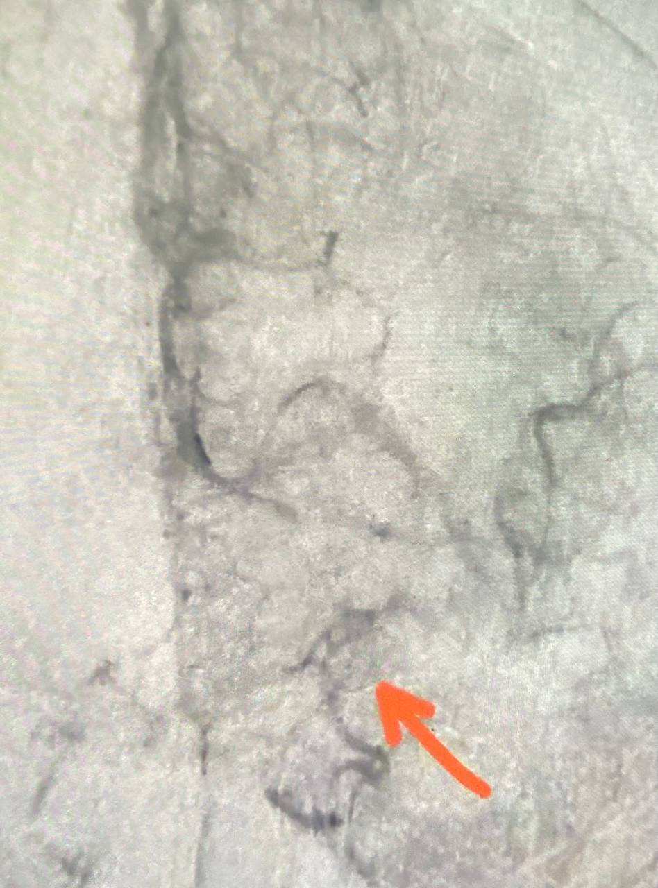 Саратовские медики спасли 20-летнюю девушку после инсульта