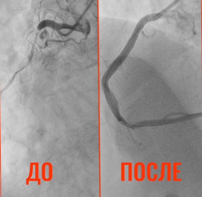 Балаковские врачи спасли 32-летнего мужчину с "сердцем старика"