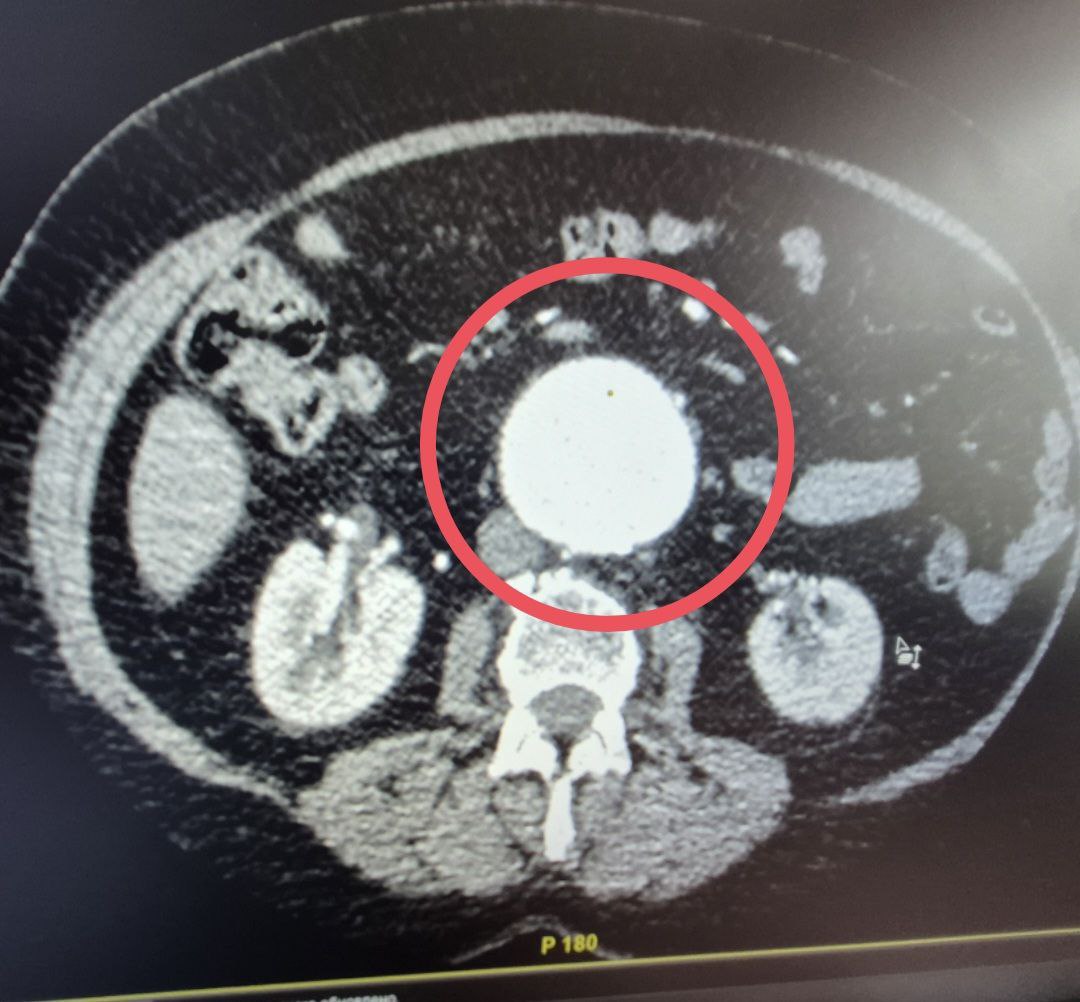 Балаковские хирурги прооперировали женщину с "бомбой замедленного действия" Балаковские хирурги прооперировали женщину с "бомбой замедленного действия"
