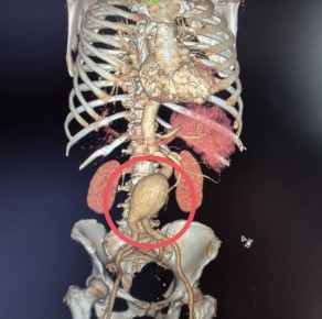 Балаковские хирурги прооперировали женщину с "бомбой замедленного действия"