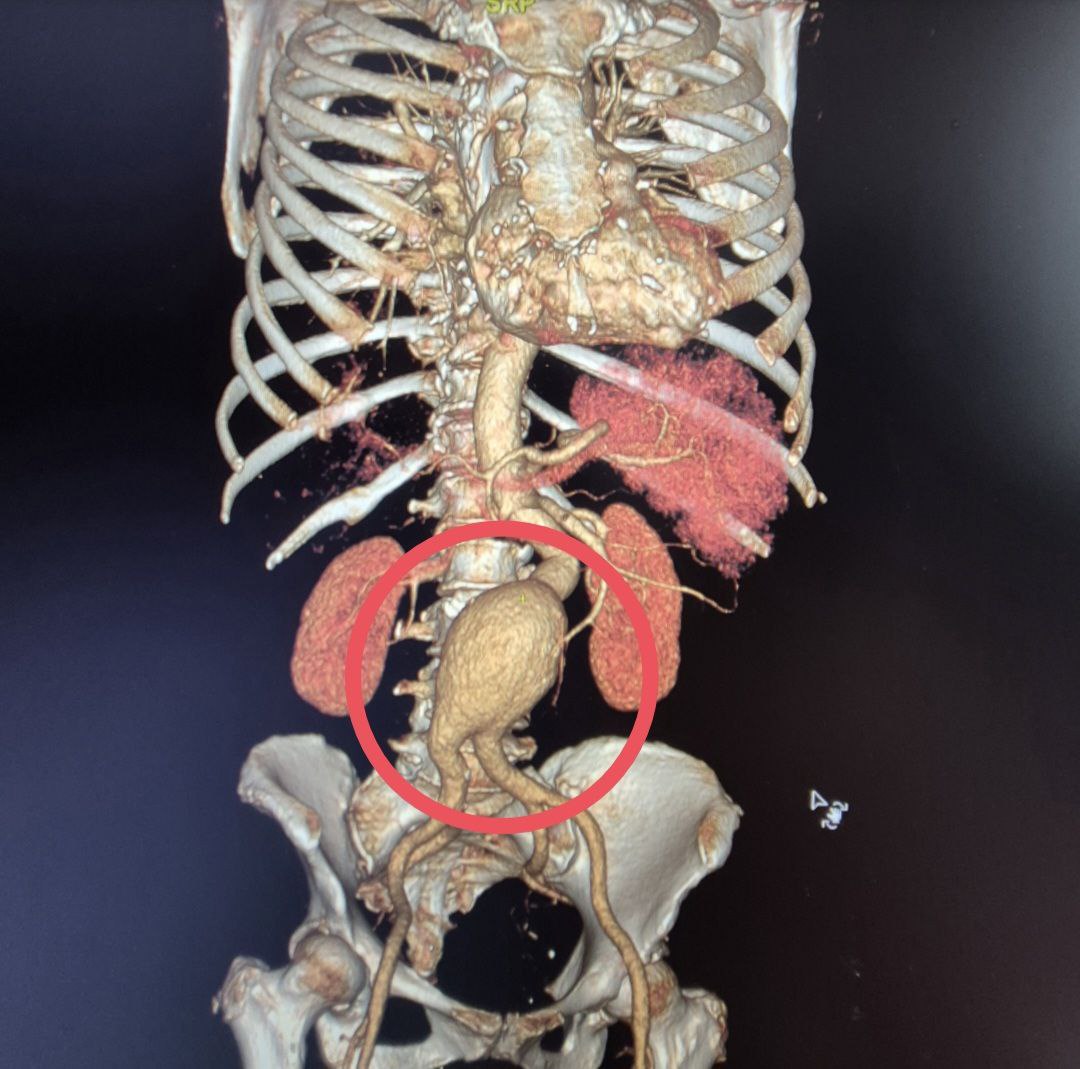 Балаковские хирурги прооперировали женщину с "бомбой замедленного действия"