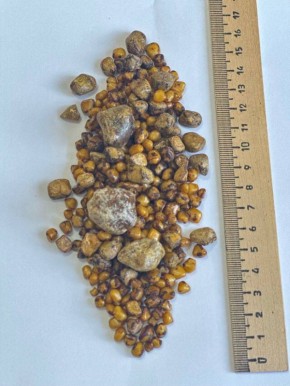 Малотравматичная операция спасла жизнь пациентке из Балакова